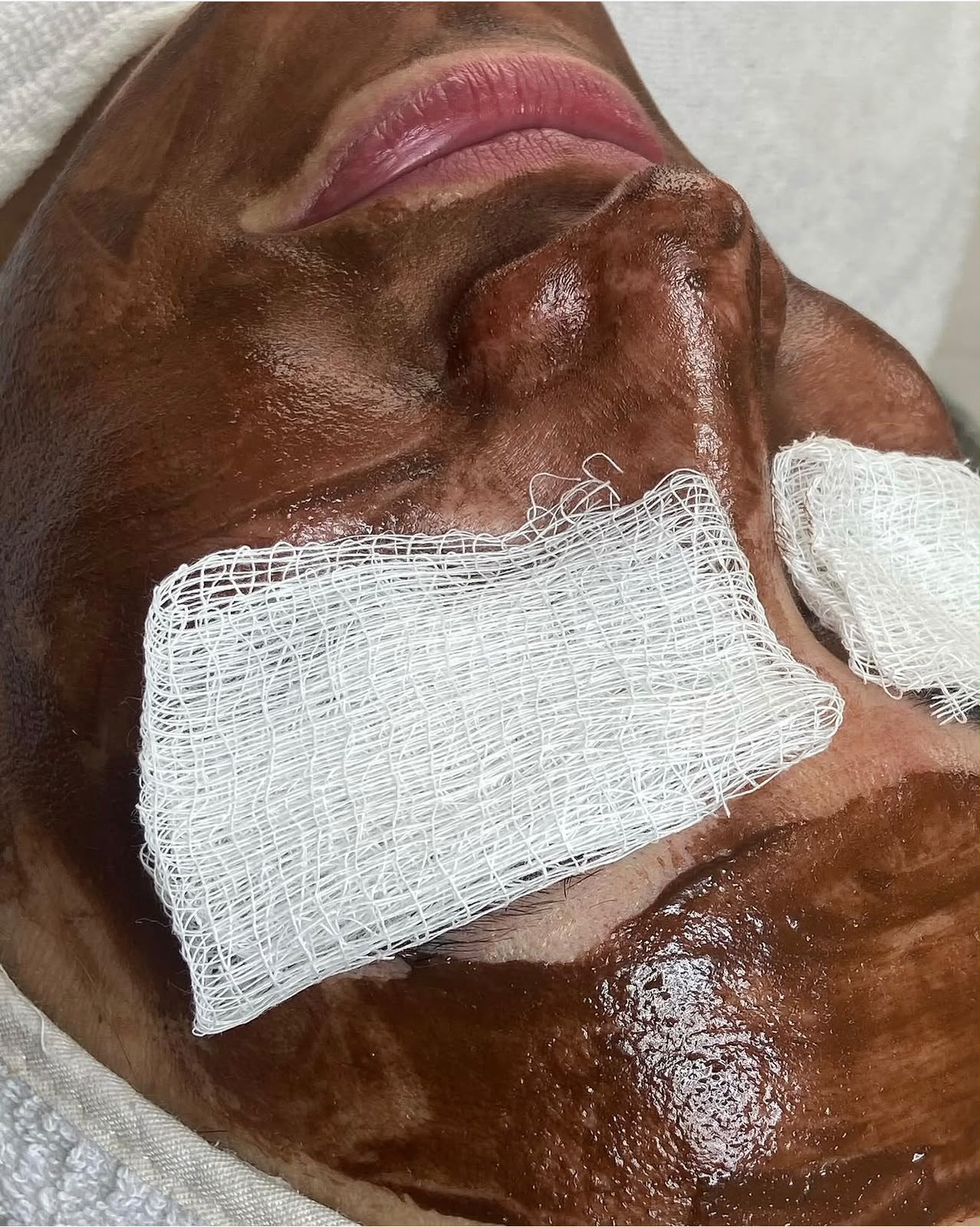 Estética Facial